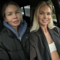 Блефаропластика